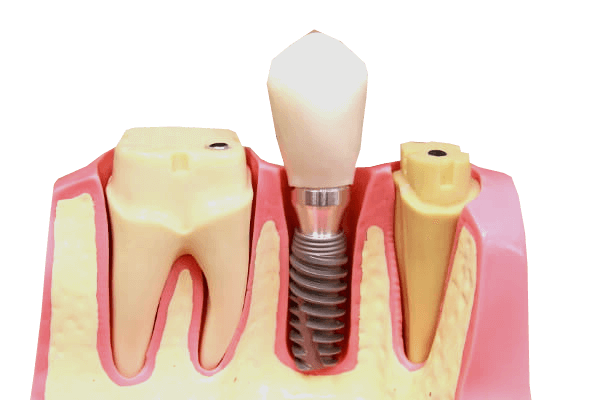 Zahn-Implantat lösung